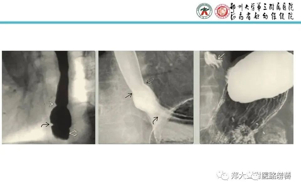 影像PPT - 食管裂孔疝CT影像表现-1