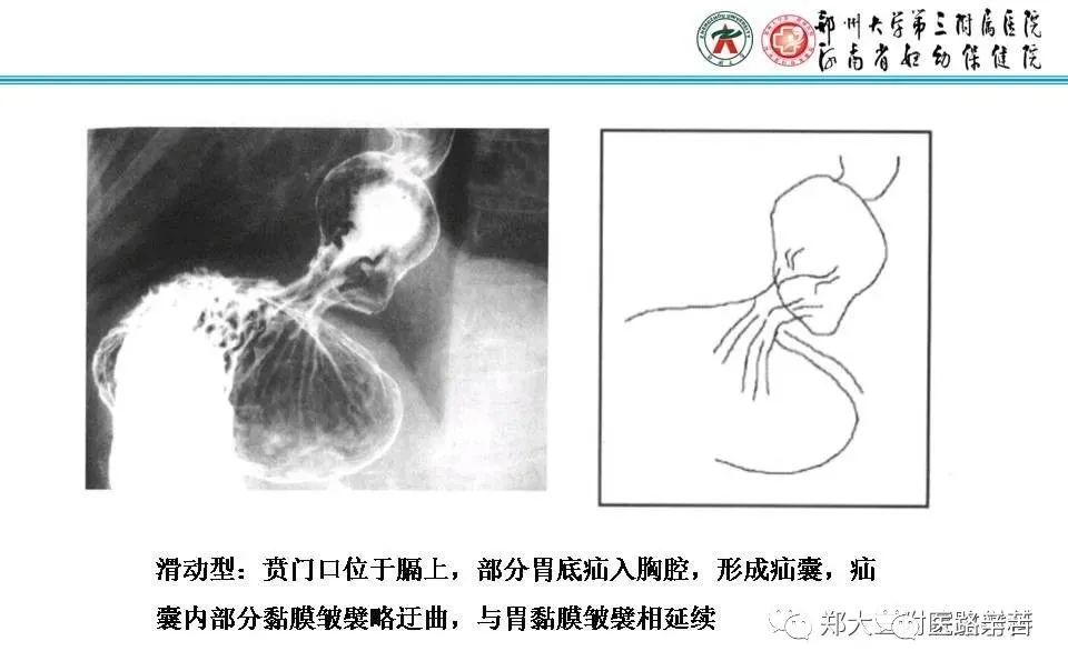 影像PPT - 食管裂孔疝CT影像表现-1