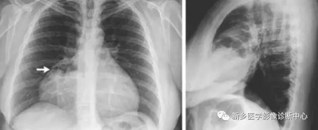 影像PPT - 食管裂孔疝CT影像表现-1