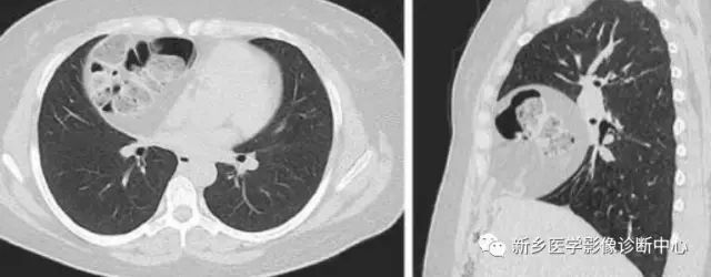 影像PPT - 食管裂孔疝CT影像表现-1