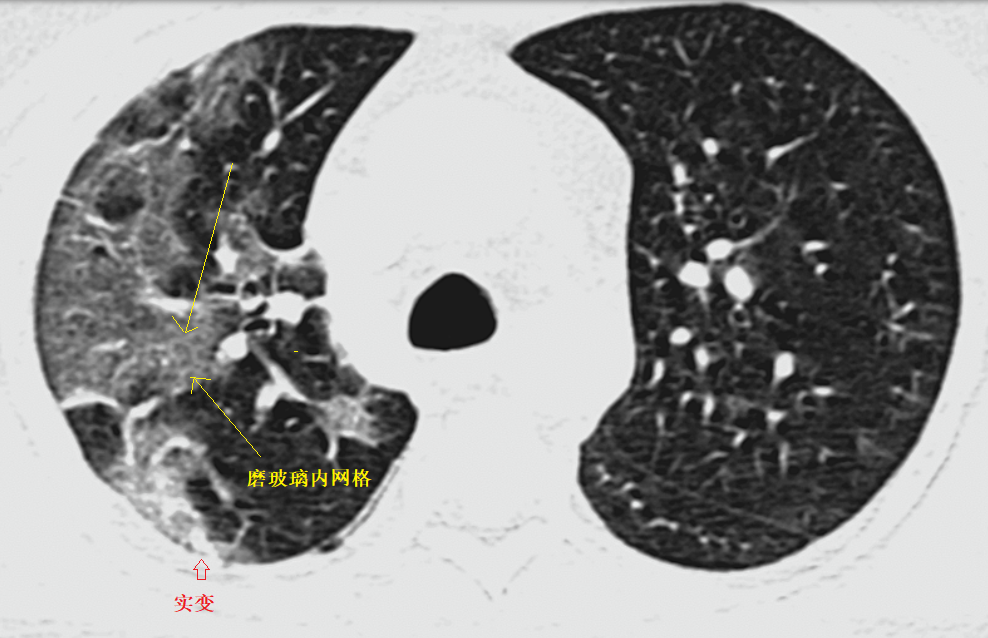影像PPT - 新冠肺炎典型影像学诊断与鉴别诊断-2