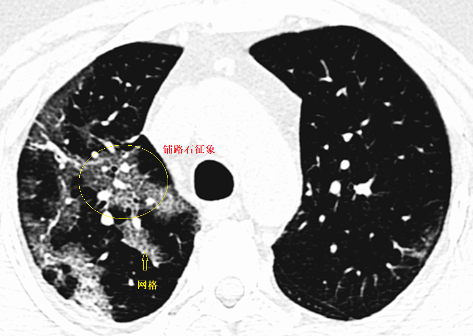 影像PPT - 新冠肺炎典型影像学诊断与鉴别诊断-4