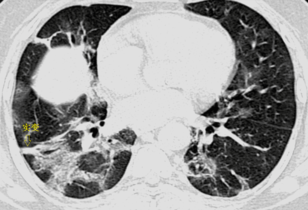 影像PPT - 新冠肺炎典型影像学诊断与鉴别诊断-3