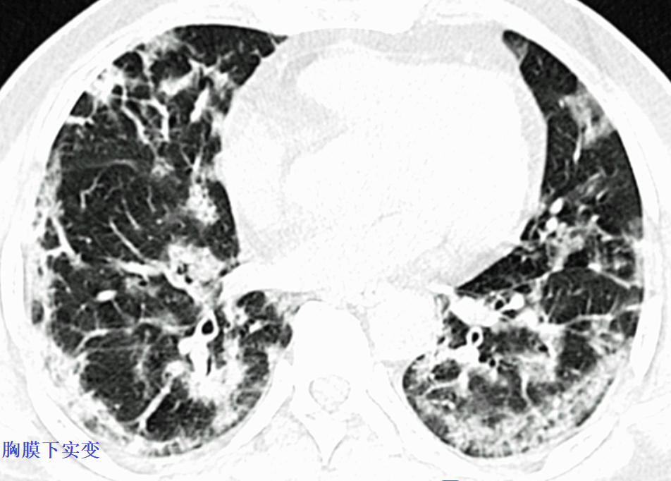 影像PPT - 新冠肺炎典型影像学诊断与鉴别诊断-5