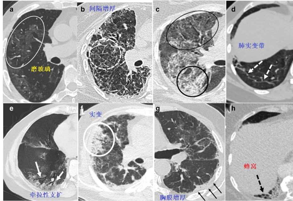 影像PPT - 新冠肺炎典型影像学诊断与鉴别诊断-6