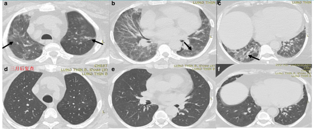 影像PPT - 新冠肺炎典型影像学诊断与鉴别诊断-7
