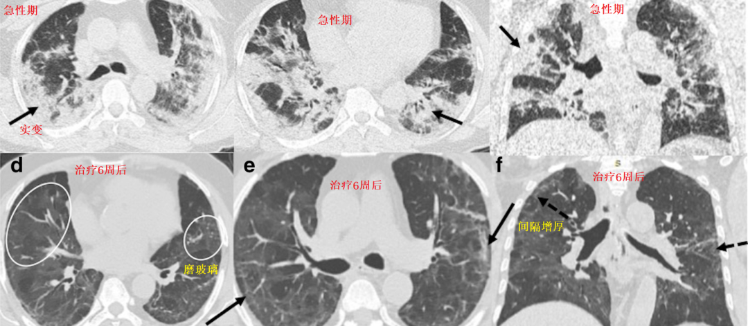 影像PPT - 新冠肺炎典型影像学诊断与鉴别诊断-8