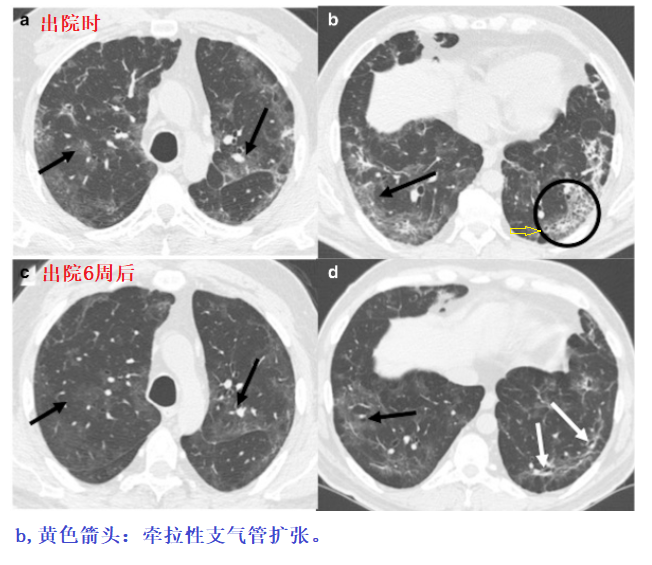 影像PPT - 新冠肺炎典型影像学诊断与鉴别诊断-9