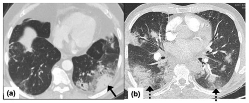 影像PPT - 新冠肺炎典型影像学诊断与鉴别诊断-11