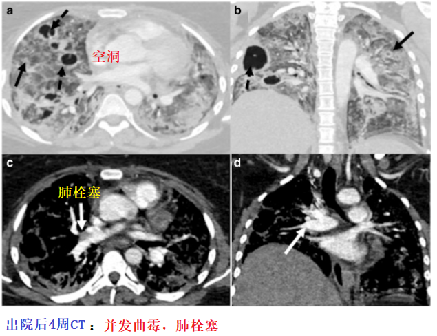 影像PPT - 新冠肺炎典型影像学诊断与鉴别诊断-16
