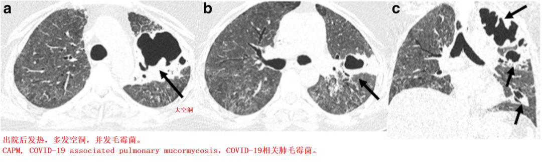 影像PPT - 新冠肺炎典型影像学诊断与鉴别诊断-17