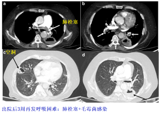 影像PPT - 新冠肺炎典型影像学诊断与鉴别诊断-18
