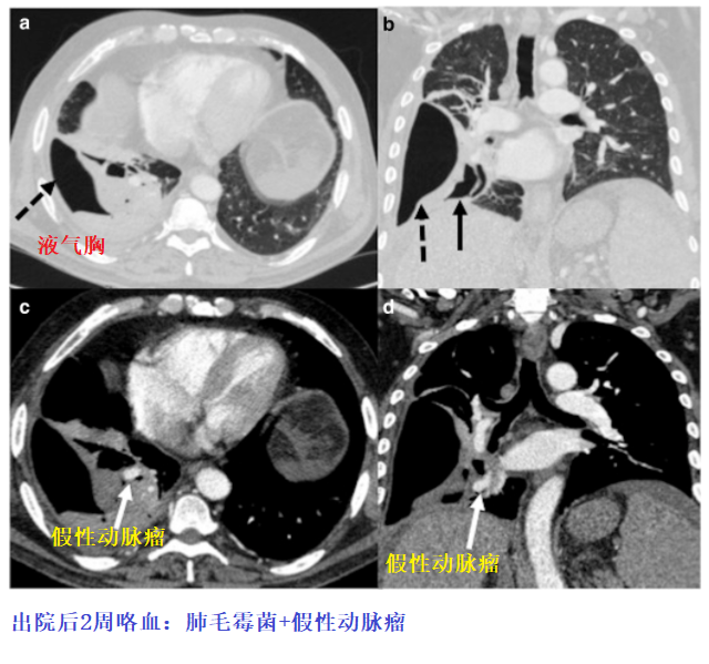 影像PPT - 新冠肺炎典型影像学诊断与鉴别诊断-19