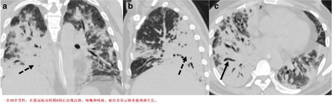 影像PPT - 新冠肺炎典型影像学诊断与鉴别诊断-20