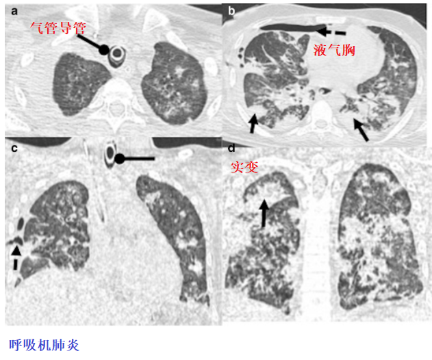 影像PPT - 新冠肺炎典型影像学诊断与鉴别诊断-21
