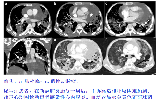 影像PPT - 新冠肺炎典型影像学诊断与鉴别诊断-22