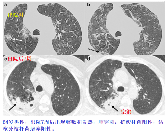 影像PPT - 新冠肺炎典型影像学诊断与鉴别诊断-23