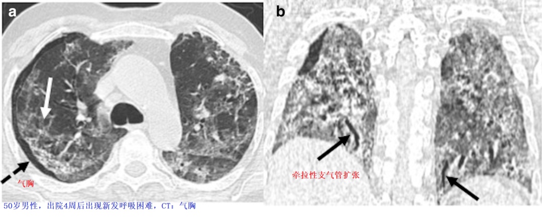 影像PPT - 新冠肺炎典型影像学诊断与鉴别诊断-24