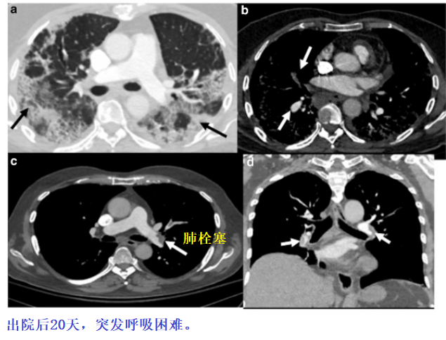 影像PPT - 新冠肺炎典型影像学诊断与鉴别诊断-25