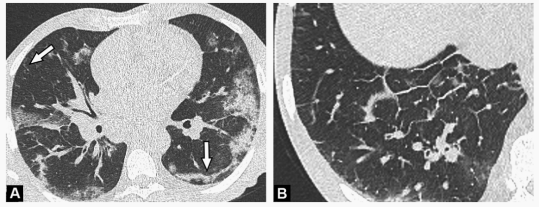 影像PPT - 新冠肺炎典型影像学诊断与鉴别诊断-26