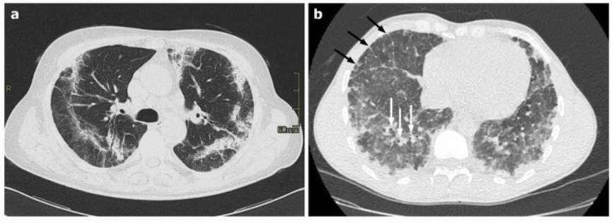 影像PPT - 新冠肺炎典型影像学诊断与鉴别诊断-30