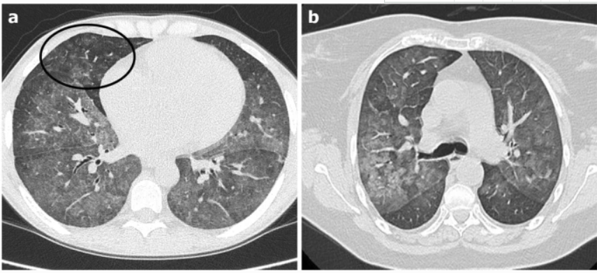 影像PPT - 新冠肺炎典型影像学诊断与鉴别诊断-31