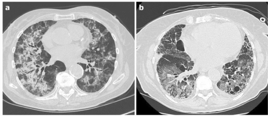 影像PPT - 新冠肺炎典型影像学诊断与鉴别诊断-32