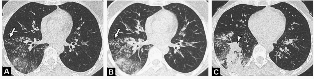 影像PPT - 新冠肺炎典型影像学诊断与鉴别诊断-34