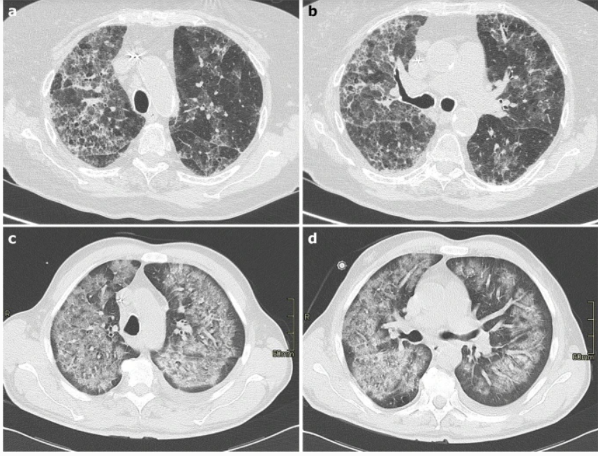 影像PPT - 新冠肺炎典型影像学诊断与鉴别诊断-33