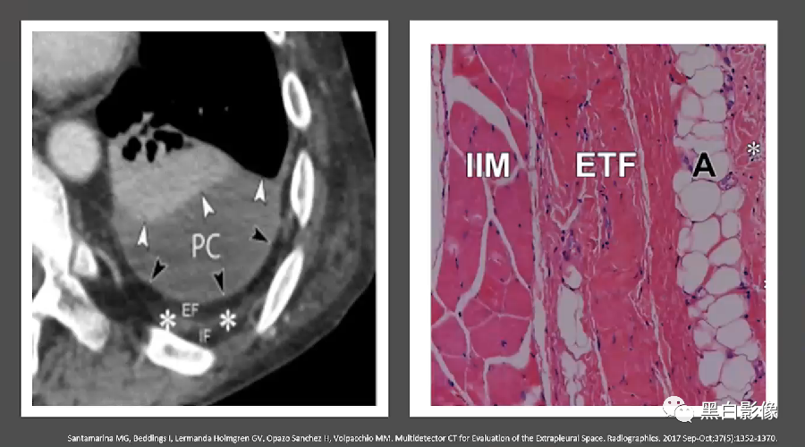 影像PPT - 【PPT】胸膜解剖及胸膜肿瘤影像诊断思路-3