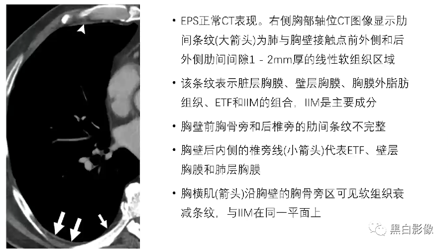 影像PPT - 【PPT】胸膜解剖及胸膜肿瘤影像诊断思路-5