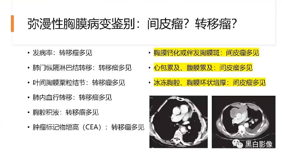 影像PPT - 【PPT】胸膜解剖及胸膜肿瘤影像诊断思路-15
