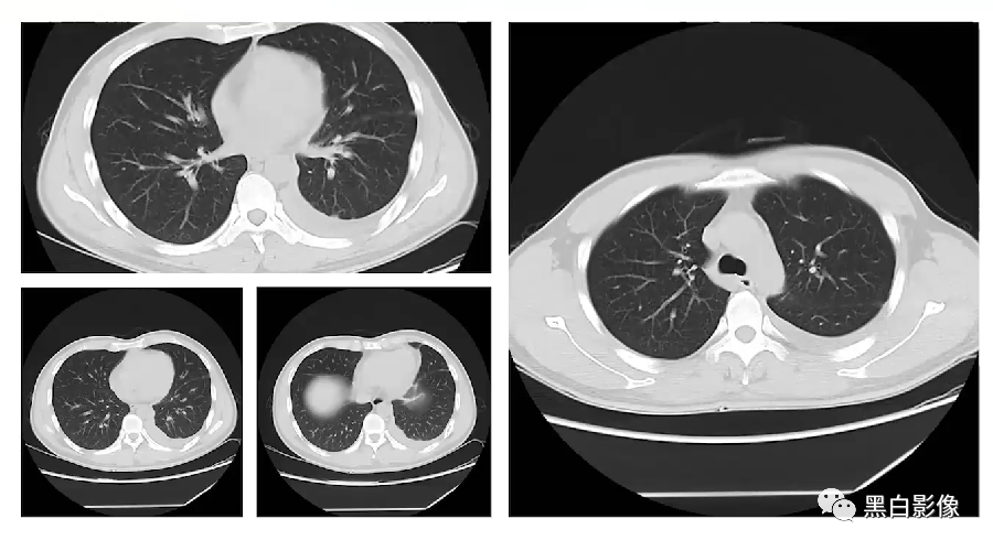 影像PPT - 【PPT】胸膜解剖及胸膜肿瘤影像诊断思路-17
