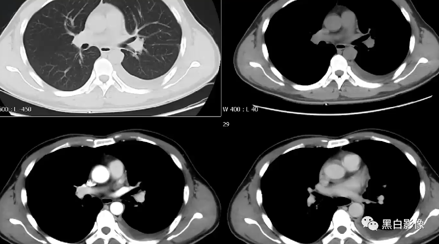 影像PPT - 【PPT】胸膜解剖及胸膜肿瘤影像诊断思路-18