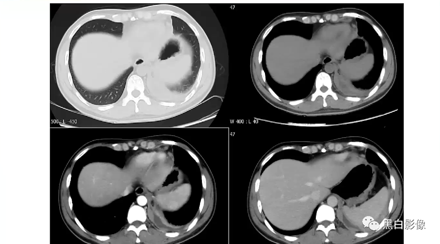 影像PPT - 【PPT】胸膜解剖及胸膜肿瘤影像诊断思路-19