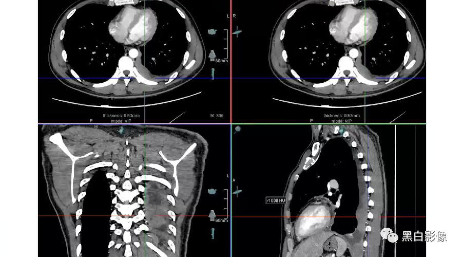 影像PPT - 【PPT】胸膜解剖及胸膜肿瘤影像诊断思路-20