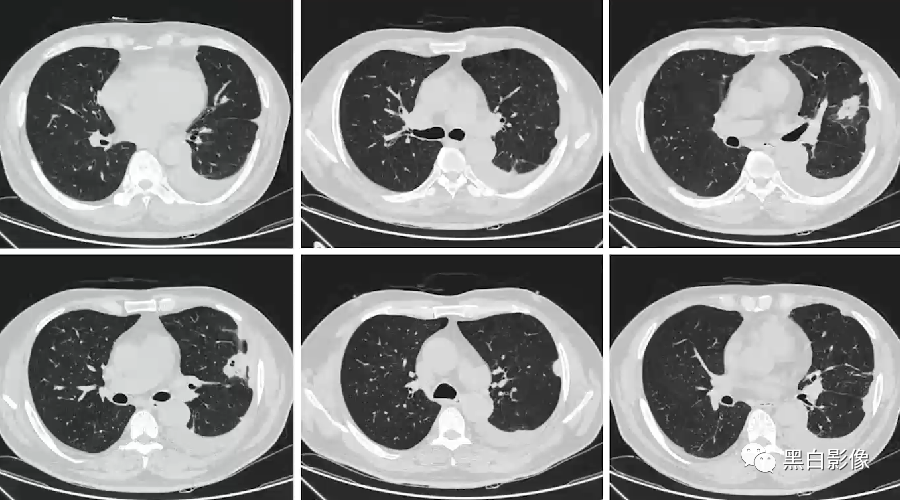 影像PPT - 【PPT】胸膜解剖及胸膜肿瘤影像诊断思路-23