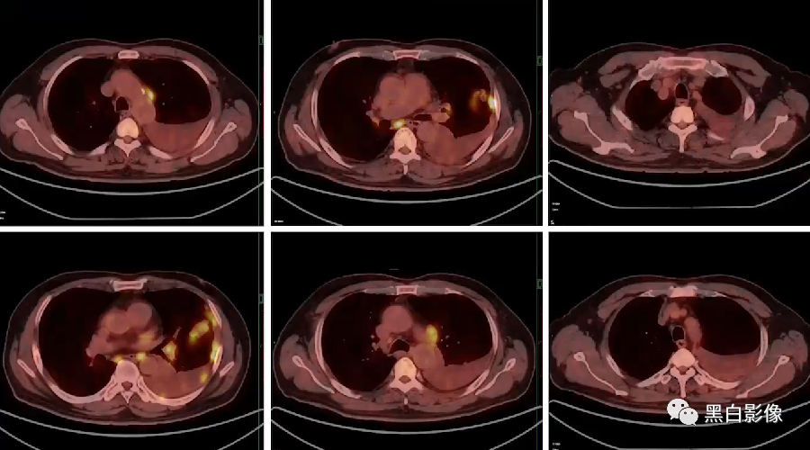 影像PPT - 【PPT】胸膜解剖及胸膜肿瘤影像诊断思路-26