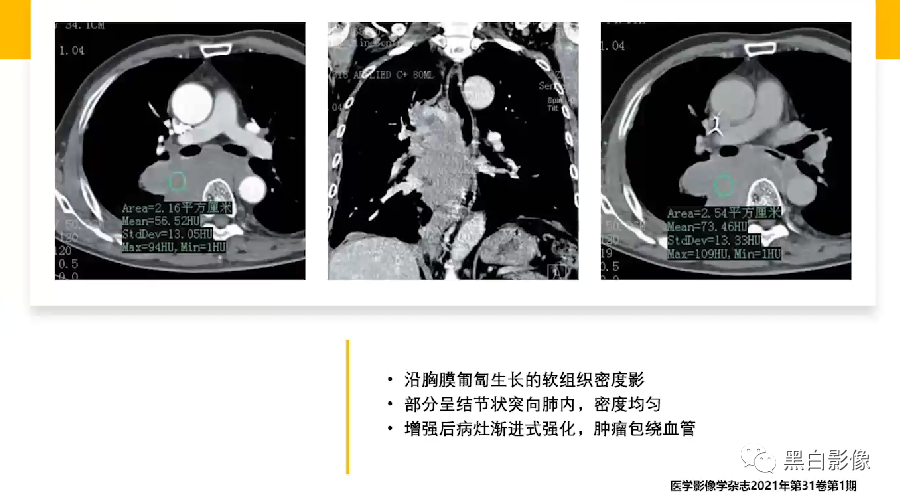 影像PPT - 【PPT】胸膜解剖及胸膜肿瘤影像诊断思路-30