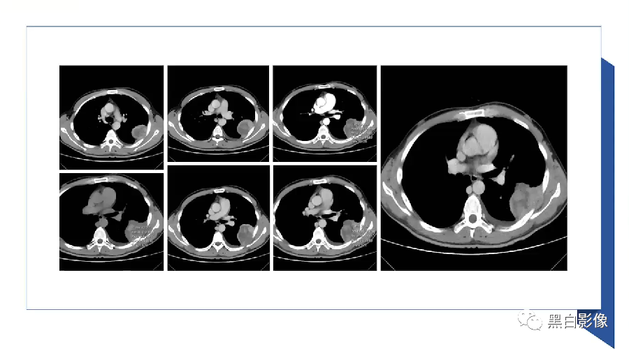 影像PPT - 【PPT】胸膜解剖及胸膜肿瘤影像诊断思路-34