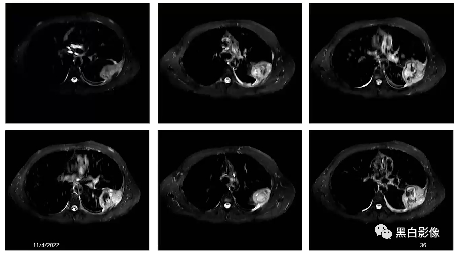影像PPT - 【PPT】胸膜解剖及胸膜肿瘤影像诊断思路-35