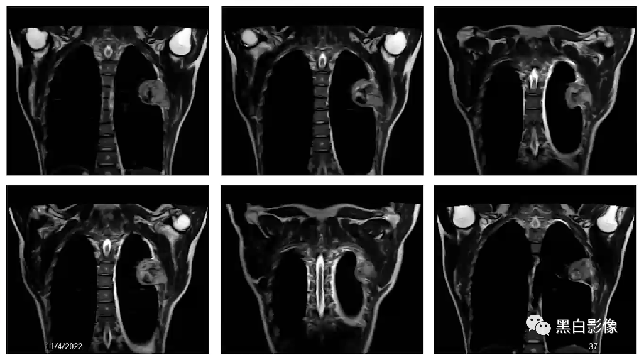影像PPT - 【PPT】胸膜解剖及胸膜肿瘤影像诊断思路-36
