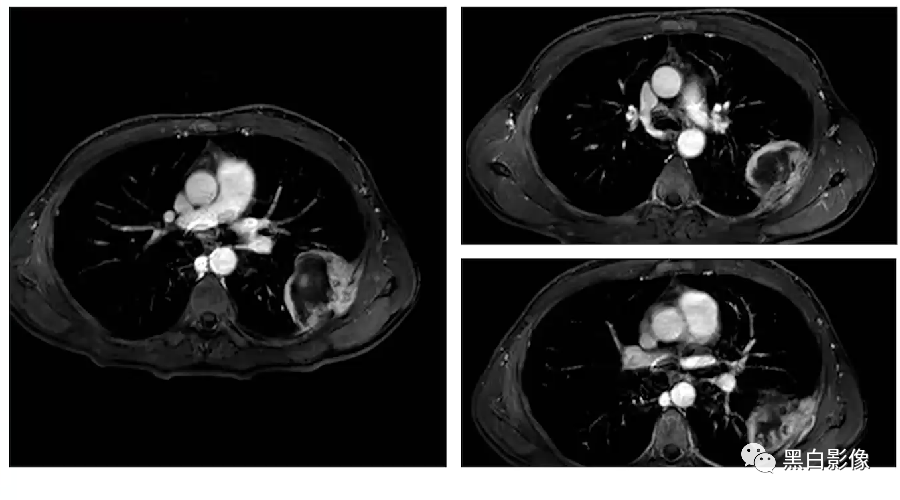 影像PPT - 【PPT】胸膜解剖及胸膜肿瘤影像诊断思路-37