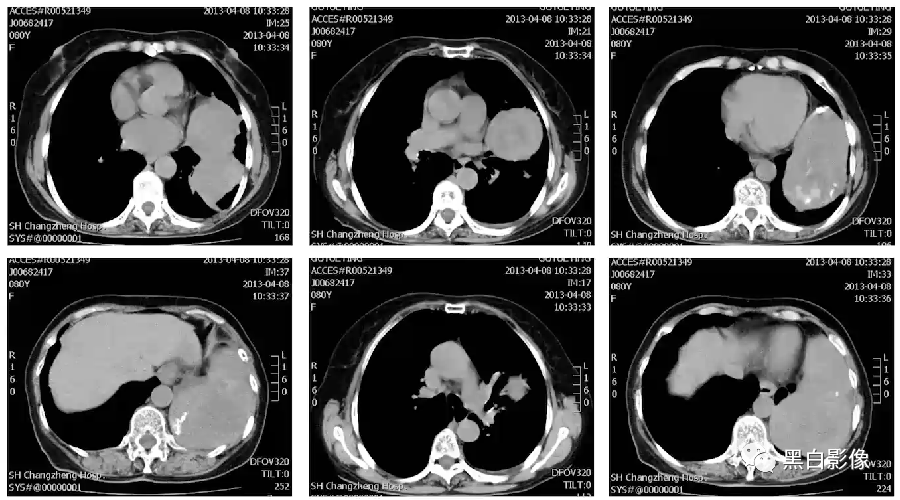 影像PPT - 【PPT】胸膜解剖及胸膜肿瘤影像诊断思路-42