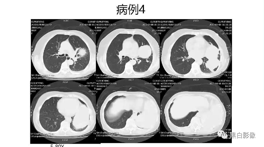 影像PPT - 【PPT】胸膜解剖及胸膜肿瘤影像诊断思路-41