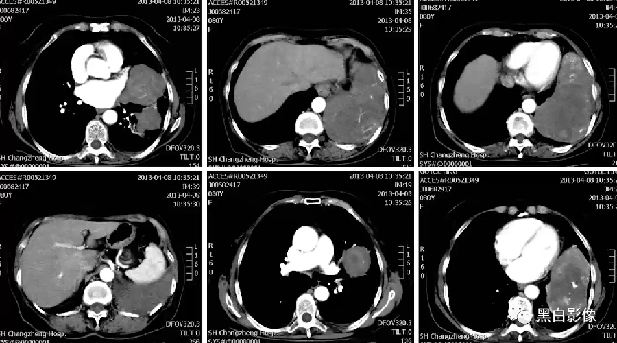 影像PPT - 【PPT】胸膜解剖及胸膜肿瘤影像诊断思路-43