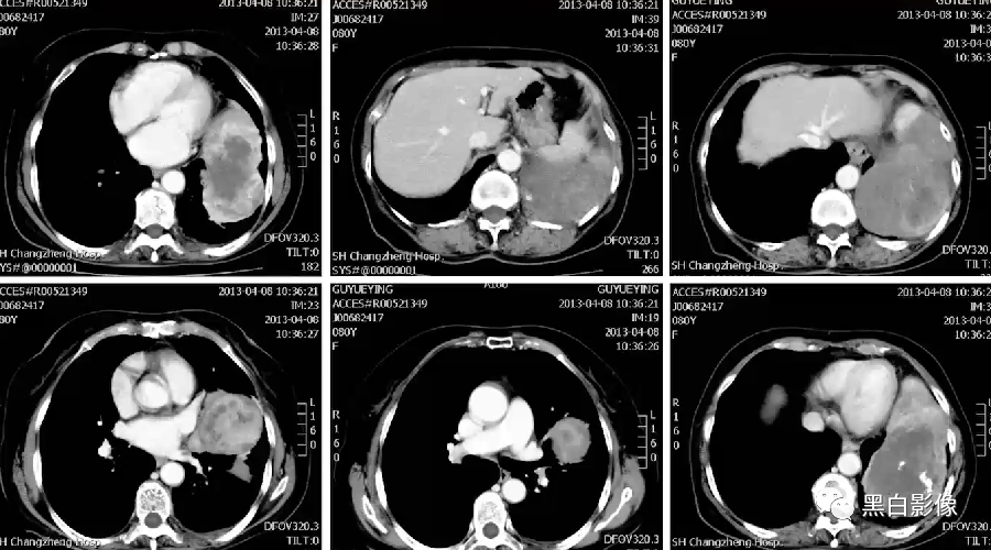 影像PPT - 【PPT】胸膜解剖及胸膜肿瘤影像诊断思路-44