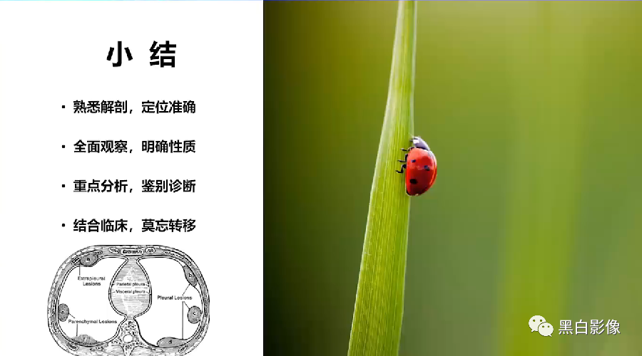 影像PPT - 【PPT】胸膜解剖及胸膜肿瘤影像诊断思路-46