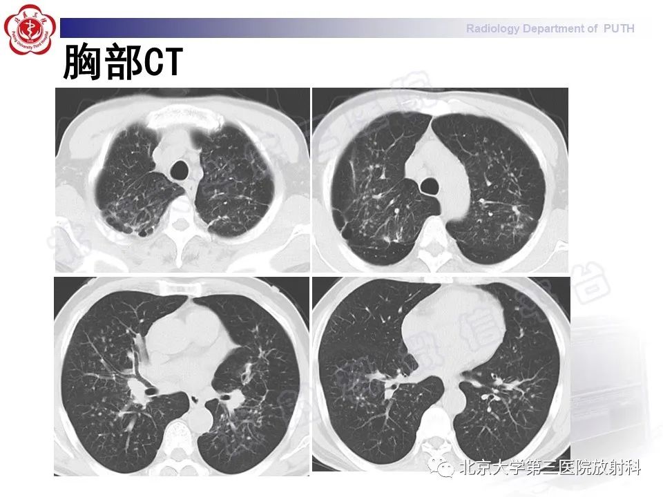影像PPT - 【PPT】矽肺-4
