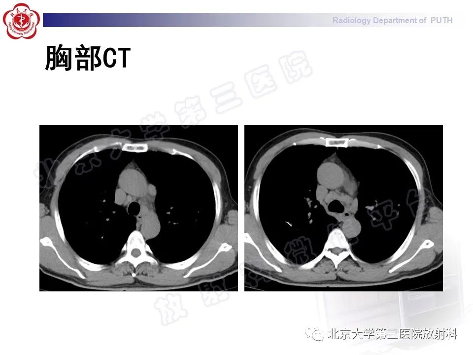 影像PPT - 【PPT】矽肺-7